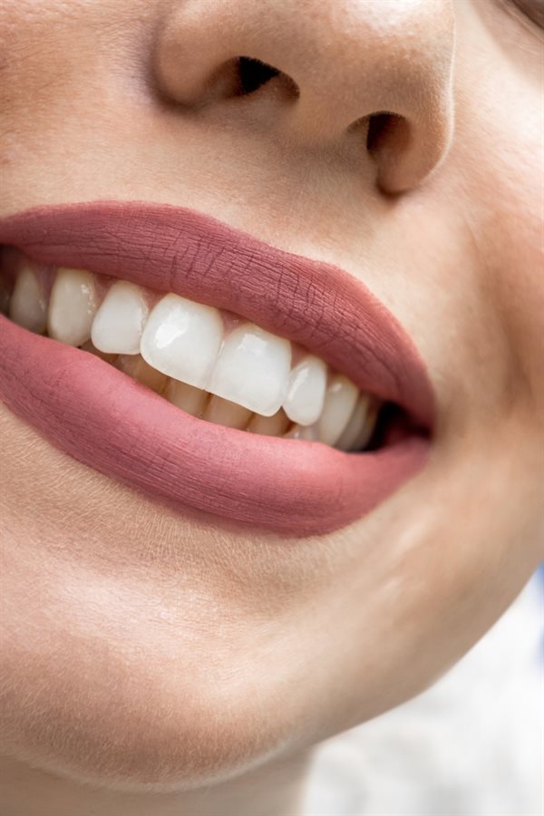 Facetas em resina ou porcelana — sorriso refinado milímetro por milímetro